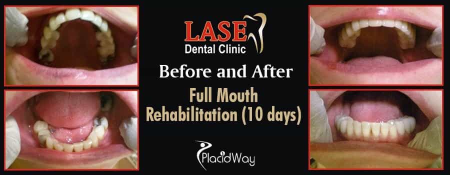 До и после полной реабилитации полости рта в Мумбаи, Индия Before and After Full Mouth Rehabilitation in Mumbai, India